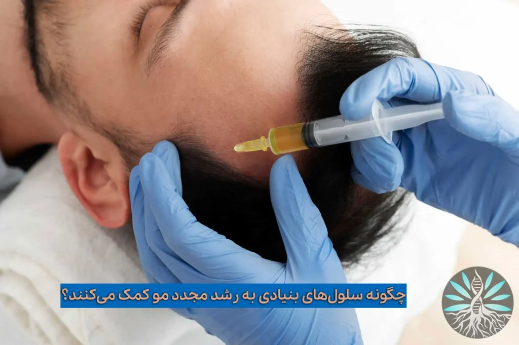 درمان ریزش مو با سلول های بنیادی