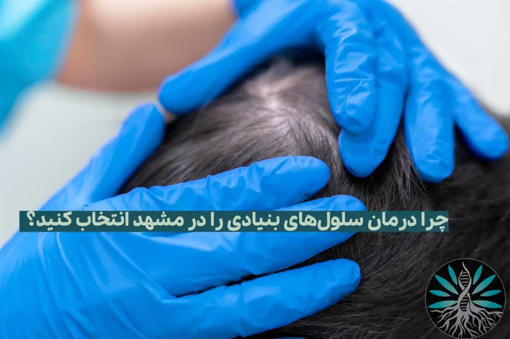 درمان ریزش مو در مشهد